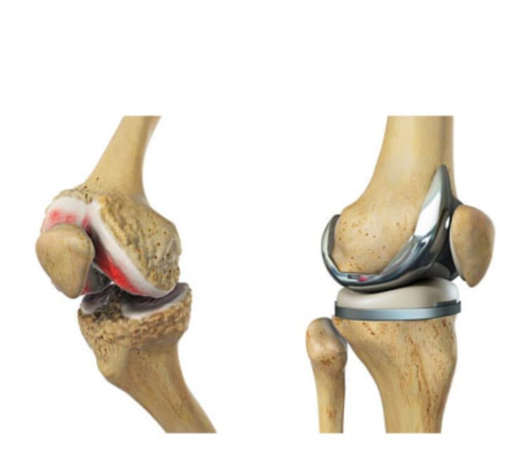 Dr. Mahesh Kulkarni - Frequently Asked Question about Knee Surgery. What is  the success rate of knee replacement surgery ? A knee replacement operation  has a high success rate, more than 95%
